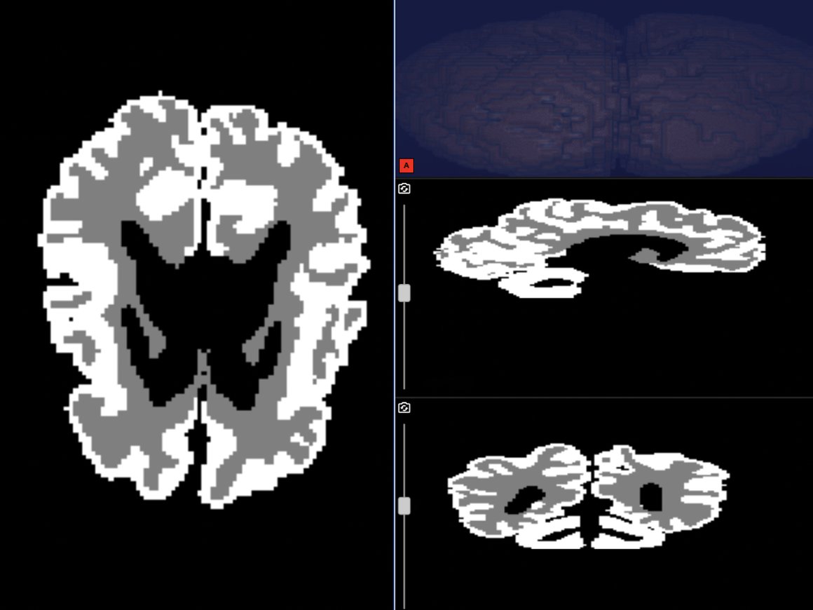 Первый в мире ИИ для МРТ младенцев: разработка Яндекса и ШАДа ускоряет диагностику ДЦП