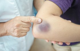 Ученые создали искусственную кожу, которая может покрываться синяками